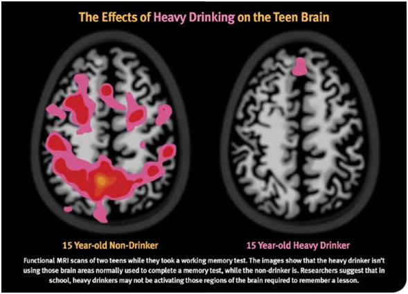 The Effects of Alcohol on the Teen Brain